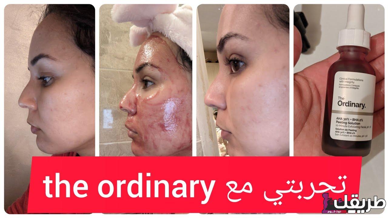 تجربتي مع ذا اورديناري مقشر البشرة الكندي الصنع 4 738625340537701